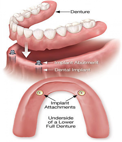 Dental Excellence Integrative Center | Nasal Breathing Program, Laser Cavity Fix and Toothaches