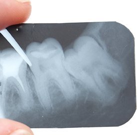Dental Excellence Integrative Center | Take Home Sleep Study, Nu Calm reg  and Nasal Breathing Program